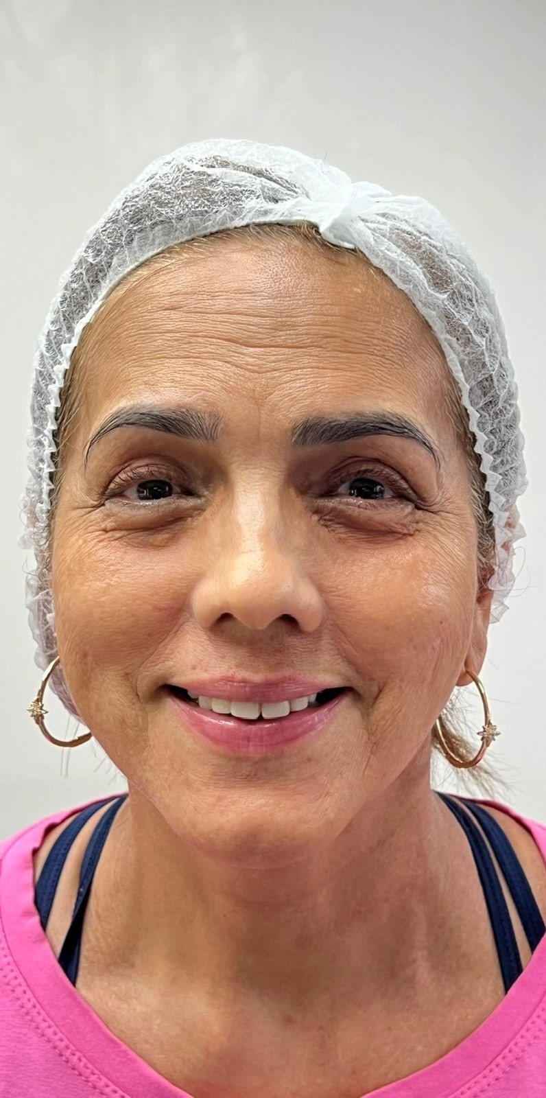 Toxina Botulínica - Rejuvenescimento Facial