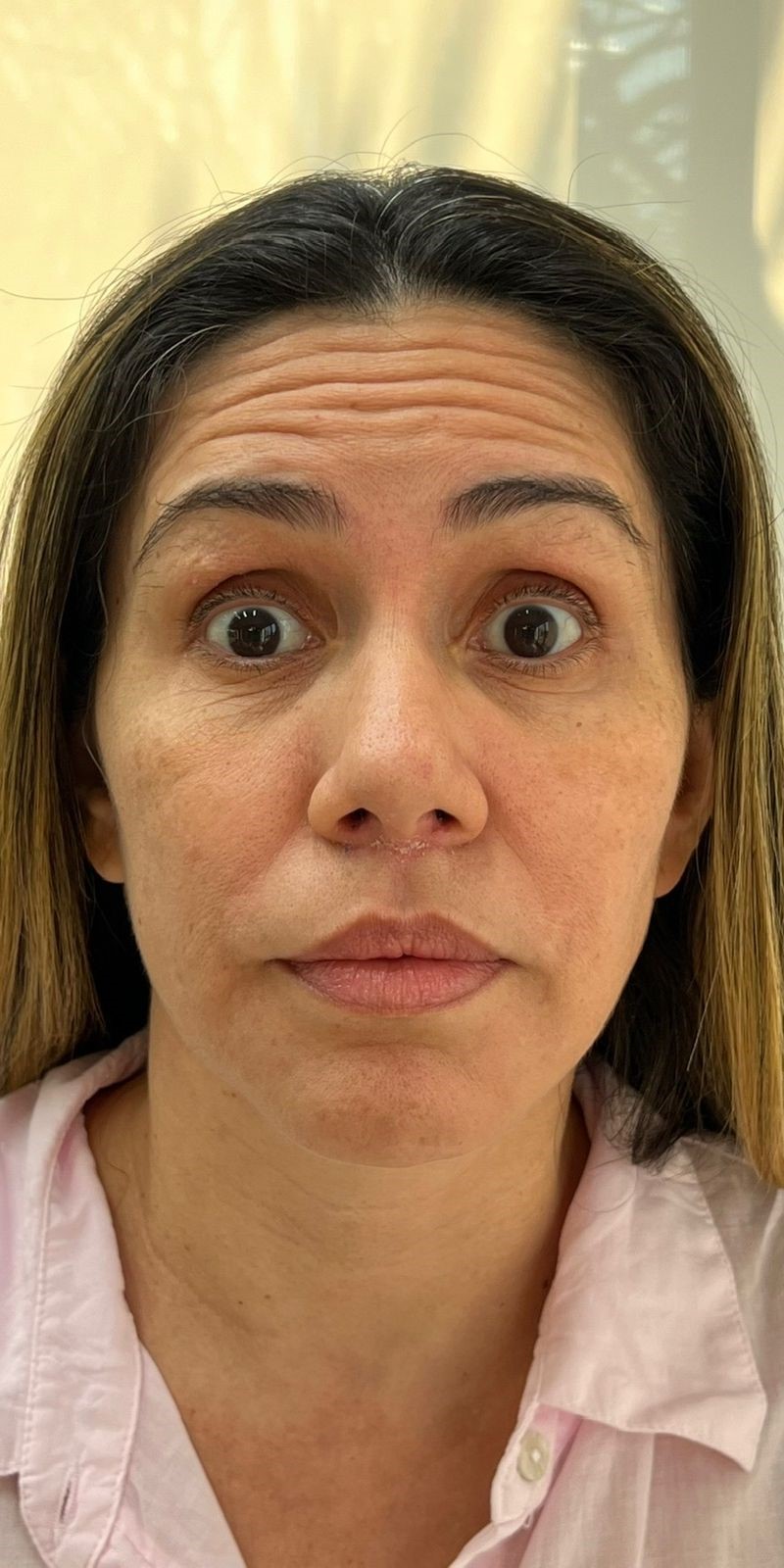 Toxina Botulínica - Testa